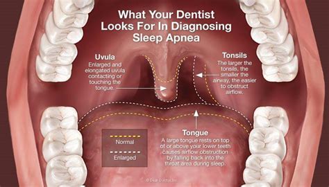 Sleep Apnea Benton Nelson Dentistry Winston Salem NC