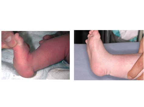 Wenn das längsgewölbe des fußes (die wölbung der fußsohle an der fußinnenseite vor dem vorfußballen) abgeflacht ist, wird dies als senkfuß bezeichnet. angeborener Plattfuß (Talus verticalis) vor und nach ...