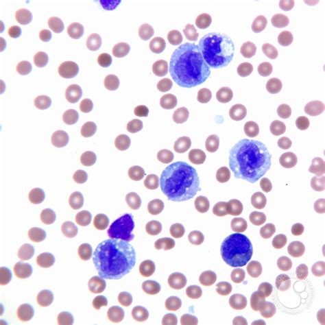 Acute Monocytic Leukemia Peripheral Blood