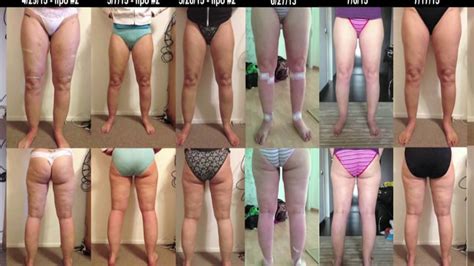Lipedema Lipoedema Awareness Days 27 And 28 Stages 1and2 Lipedema Before And After Liposuction Youtube