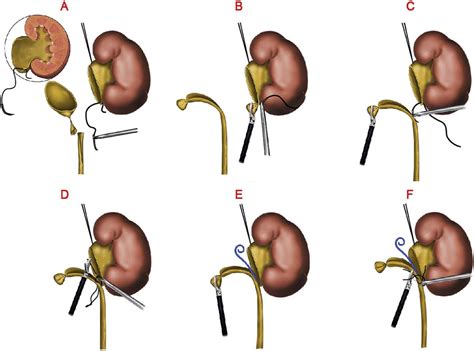 Comparison Of Laparoscopic Approaches For Dismembered Pyeloplasty In