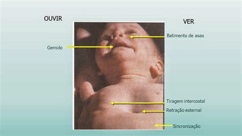 Tiragem Intercostal E Subcostal