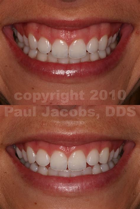 Dental Nation: Gummy Smile Solution with Lip Repositioning Surgery