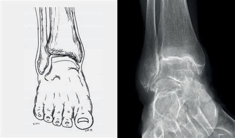 Osteoarthritis Of The Upper Ankle Joint Leonardo