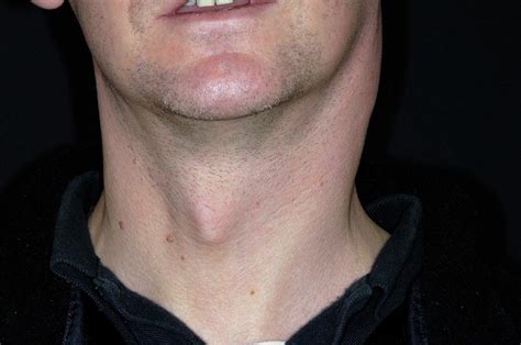 Swollen Lymph Nodes In Tonsillitis Photograph By Dr P Marazzi Science Photo Library