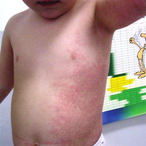 Erythematous Papules On The Left Sides Of The Chest Abdomen Arm And
