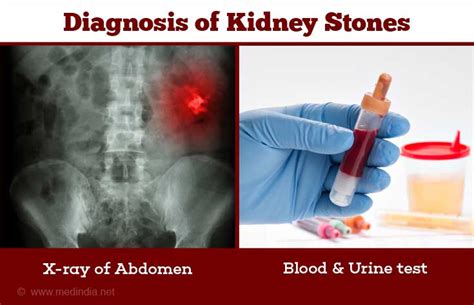 How Can We Diagnose Kidney Stones