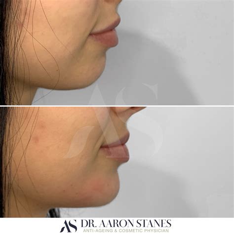 Jawline Contouring Example 8 Dr Aaron Stanes Anti Ageing And