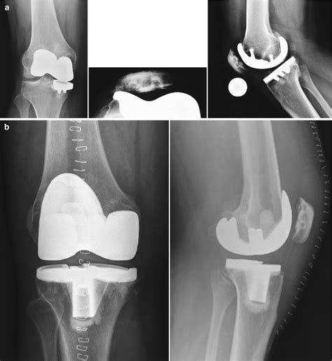 Progression And Component Failure In Unicompartmental Knee Arthroplasty