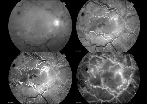 Central Retinal Vein Occlusion Crvo Fluorescein Angiography