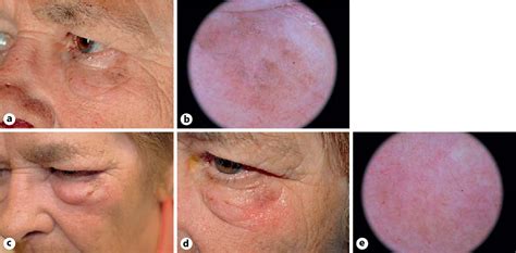 Figure 1 From Bowenoid Actinic Keratosis And Bowens Disease Treated