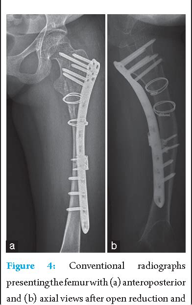 Figure 4 From The Reversed Less Invasive Stabilisation System Distal