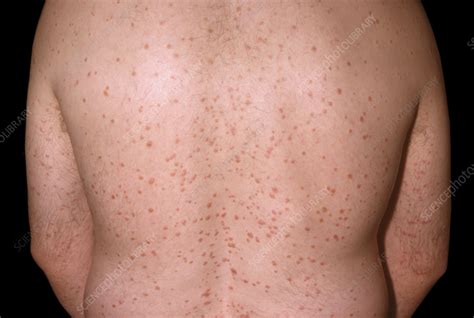 Guttate Psoriasis On A Mans Back Stock Image C0585878 Science