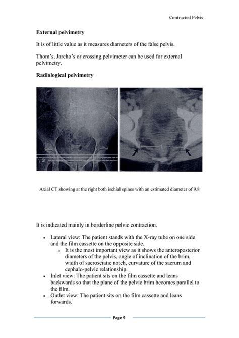 Contracted Pelvis Diagnosis And Treatment Pdf