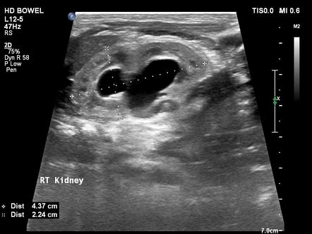 Imperforate Hymen In Newborn Image Radiopaedia Org