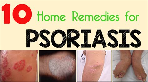 10 Home Remedies For Psoriasis
