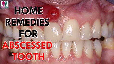 Home Remedies For Abscessed Tooth Health Sutra Youtube