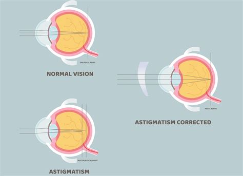 Astigmatism Symptoms Causes Treatment Kraff Eye Institute