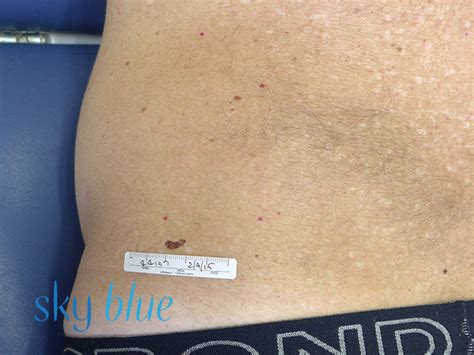 Melanoma Lower Back 1ax Sky Blue Dermatology