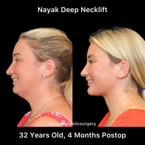 Before And After Deep Necklift Procedures In St Louis Mo Nayak