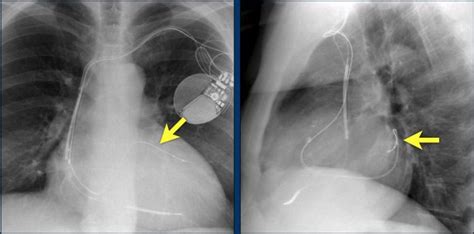 The Radiology Assistant Cardiovascular Devices