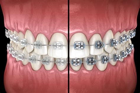 Ceramic Or Metal Braces Which Should I Choose Melbourne Orthodontics