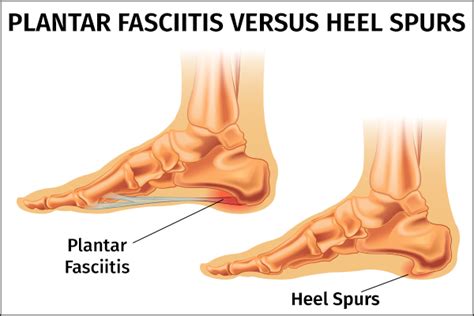 Heel Spurs And Plantar Fasciitis What S The Difference Ankle Hot Sex Picture