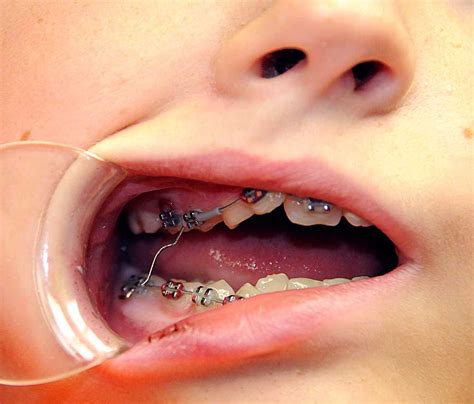 22 What Is The Wire In Braces For You Wellnessurlaub Deutschland