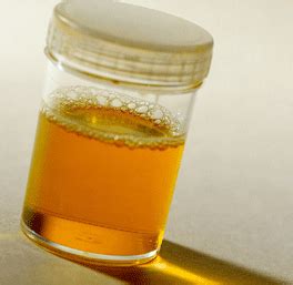 Proteinuria, or protein in urine, refers to the leakage out of protein ...