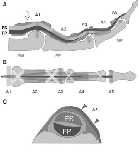 If the tendon is lacerated and the distal tendon stump is less than 1 cm long, fdp tendon 45. Schematic of the normal flexor tendon anatomy of the ...