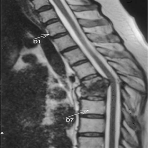 Showing Contiguous And Skip Lesions In Potts Spine A Spinal Mri Of A