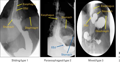 Figure From Morphology Of The Esophageal Hiatus Is It Different In Types Of Hiatus Hernias
