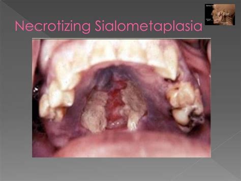 Differential Diagnosis Of Salivary Gland Lesions Ppt