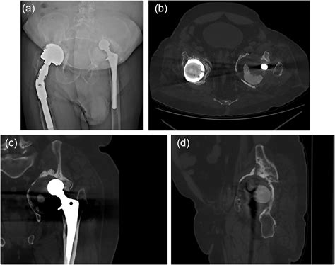 The Diagnosis And Treatment Of Acetabular Bone Loss In Revision Hip