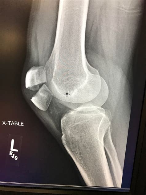 Broken Knee Cap Rbrokenbones