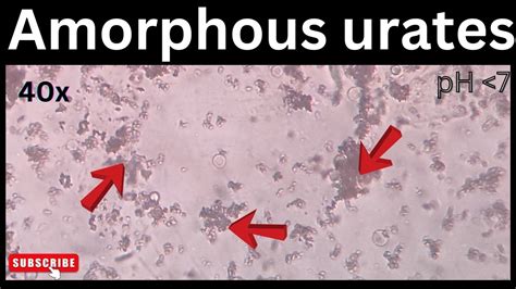 Amorphous Urates In Urine Medicallabtechnologysajal6903 YouTube