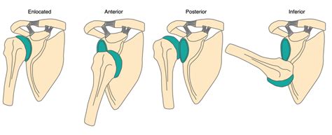Shoulder Dislocation Orthosho