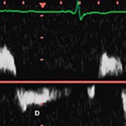 Spectral Doppler Waveforms Demonstrate Laminar A Disturbed B And