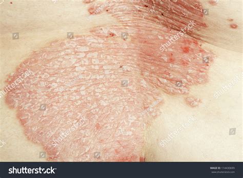 Psoriasis Vulgaris Autoimmune Disease That Affects Stock Photo