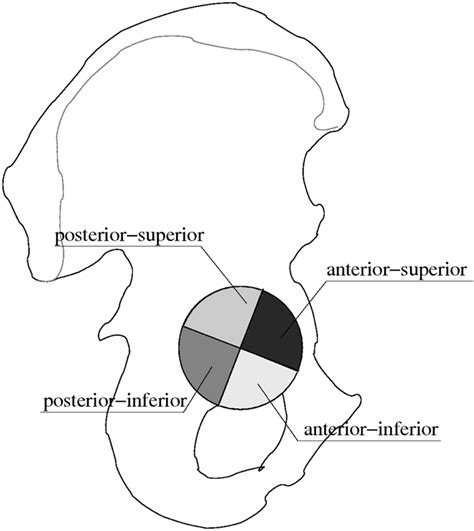 Schematic View Of Pelvis With Denoted Quadrants Of Acetabulum