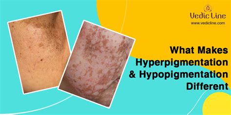 Hyperpigmention And Hypopigmentation Is Lower In Certain Areas Of Your Skin
