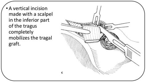 Technique Of Harvesting Cartilage Graft For Cartilage Tympanoplasty