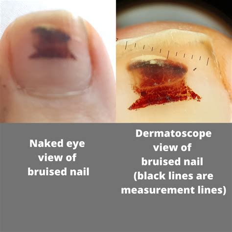 Dermoscopy Getting Up Close To The Skin On Your Feet West Berkshire