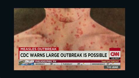 Measles Case Reported In Another State Cnn