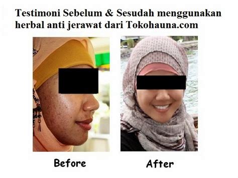 Namun, adakah di antara anda yang pernah mengalami jerawat gatal? Cara Menghilangkan Jerawat Gatal / Cara menghilangkan ...