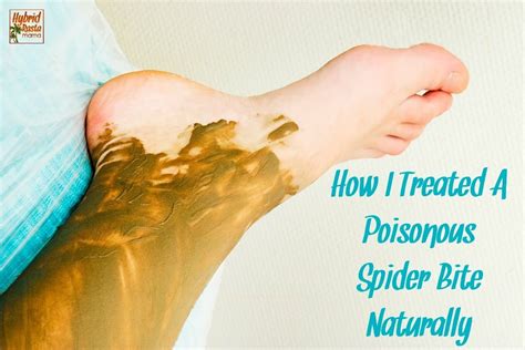 How To Treat A Spider Bite At Home Hybrid Rasta Mama