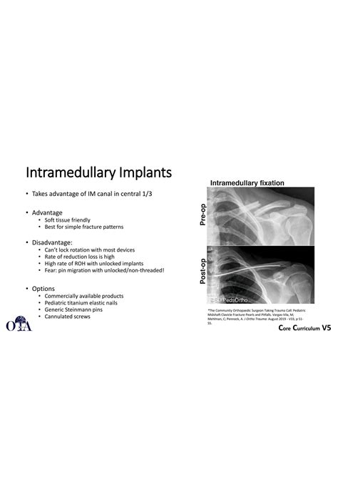 Solution Implants And Technique Clavicle Fractures Anatomy Medical