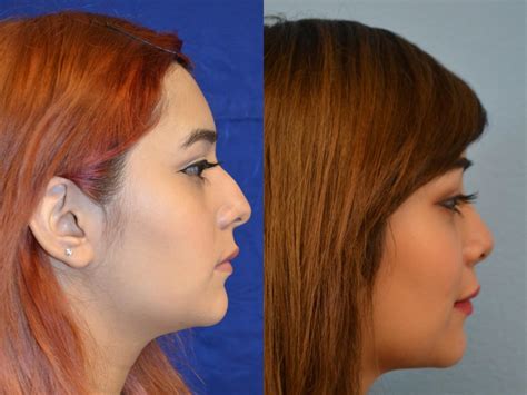 Nose Surgery Before And After Photos Patient 166 San Francisco Ca