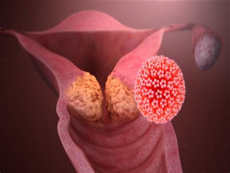Cervical Cancer Survival May Improve By Targeting Senescent Zombie Cells ANI BW Businessworld