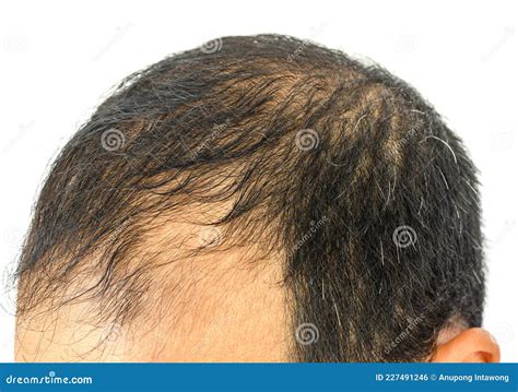 Close Up Of Male Pattern Baldness Typically Appears First At The